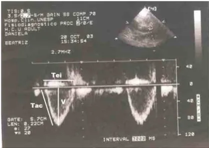 Figura 7 – Imagem ecocardiográfica normal, em modo Doppler, mostrando fluxo em  Artéria Pulmonar, logo após a emergência da válvula
