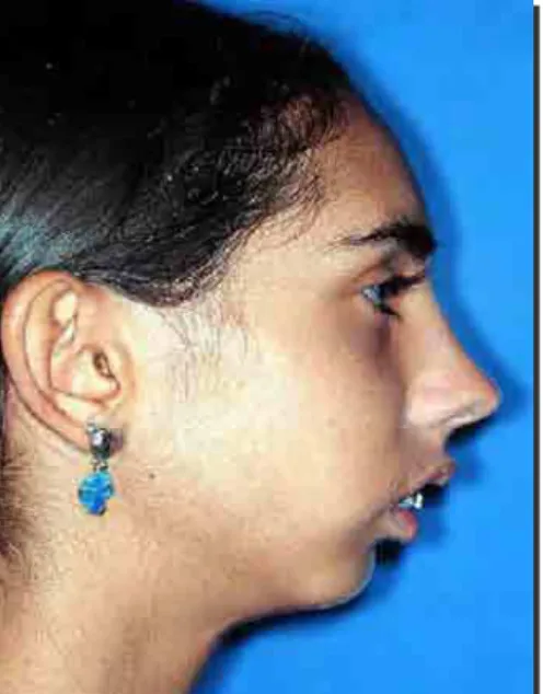 FIGURA 2 - Fotografia do perfil de paciente  Padrão Face Longa. 