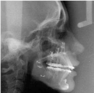 FIGURA 2 - Telerradiografia pós-operatória de paciente Padrão Face Longa.19%34%31%13%3%53%47%