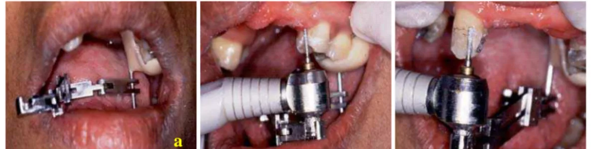 FIGURA 6 – a) verificação da estabilidade do conjunto na boca; b)  realização do preparo no dente 24; c) realização do preparo  no dente 13