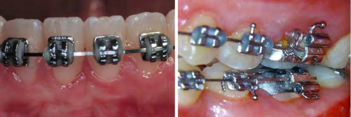 FIGURA 1 - Aparelho ortodôntico fixo com bandas instaladas nos  primeiros molares permanentes e brackets colados em pré-molares e  dentes anteriores  