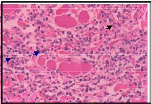 FIGURA 09.Transição dermosubcutânea ao 15 o  dia de infecção,   demonstrando um infiltrado  linfoplasmocítico (setas ázuis) e  macrófagos epitelióises (seta preta), em felinos (Felis catus)  infectados experimentalmente com S.schenckii (H&amp;E- 100X)