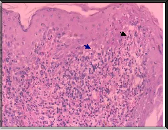 FIGURA 12.  Acantose, degeneração  hidrópica de ceratinócitos basais (seta azul),  incontinência pigmentar e exocitose neutrofílica (seta preta)  associado a intenso infiltrado inflamatório misto na derme papilar, ao  30 o  dia infecção, em felinos com esp