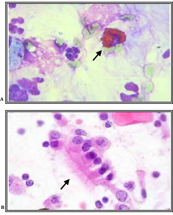 Figura 5 – Eosinófilos (A) e células epiteliais cilíndricas ciliadas (B)  de células do lavado broncoalveolar de cavalos QM, submetidos ao  exercício— Giemsa (1000x)