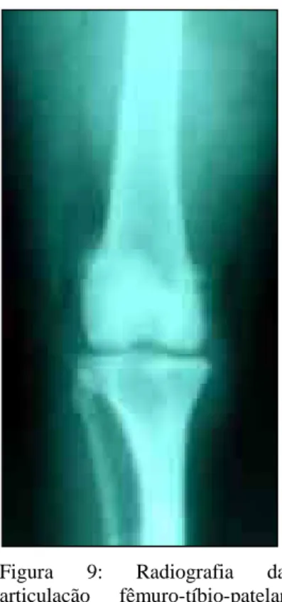 Figura 9: Radiografia da articulação fêmuro-tíbio-patelar esquerda em projeção  antero-posterior