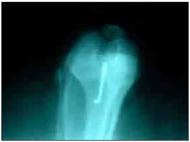 Figura 12: Aspecto radiográfico da articulação femurotíbiopatelar esquerda em posição skyline aos 90 dias de pós-operatório
