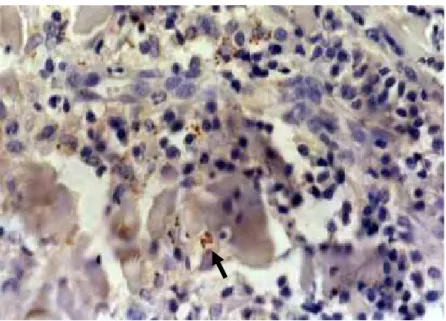 FIGURA 5 – Reação de imunoistoquímica positiva para Leishmania sp. na  biópsia de pele, coletada da região da pina (400x) 