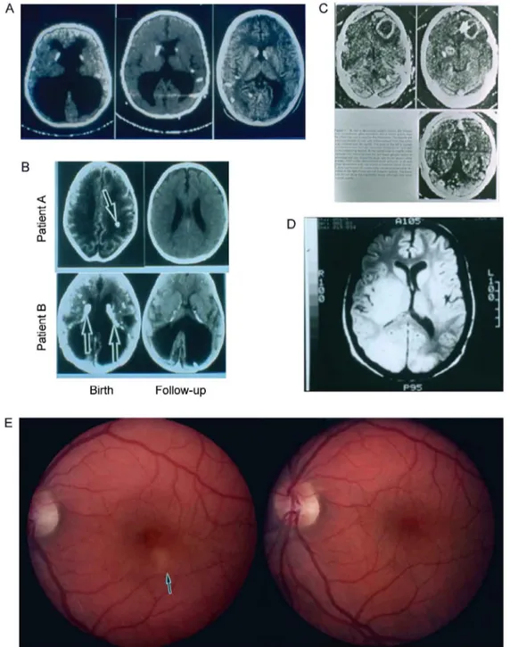 Fig. 2A: resolution of hydrocephalus and brain growth following treatment and shunt in child with congenital toxoplasmosis (Swisher et al