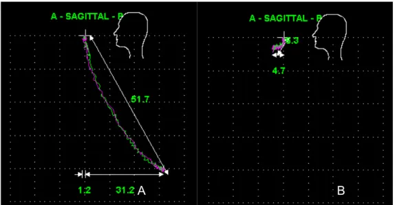 FIGURA 18 – Registros eletrognatográficos durante máxima abertura  bucal (A) e protrusão máxima (B) avaliada no plano  sagital