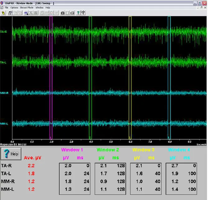 FIGURA 21 – Registros eletromiográficos durante o repouso mandibular dos  músculos temporais anteriores direito (TA-R) e esquerdo (TA-L) e  masseteres direito (MM-R) e esquerdo (MM-L)