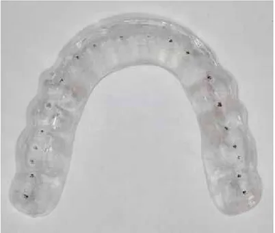 FIGURA 5 - Pontos de contato com os dentes mandibulares. 