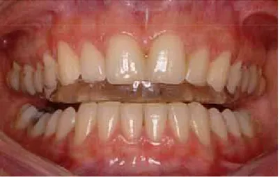 FIGURA 6 – Protrusão com desoclusão dos  dentes posteriores pelos dentes  anteriores. 