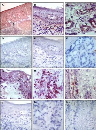 Fig.  2:  immunolabelling  of  chemokine  in  lesions  American  cutane- cutane-ous leishmaniasis