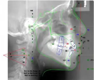 Figura 2 – Telerradiografia cefalométrica lateral digital com a sobreposição do traçado  cefalométrico