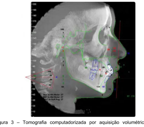 Figura 3 – Tomografia computadorizada por aquisição volumétrica CBTC em norma  ortogonal com a sobreposição do traçado cefalométrico