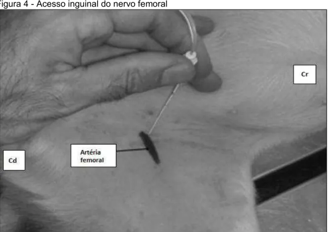 Figura 4 - Acesso inguinal do nervo femoral 