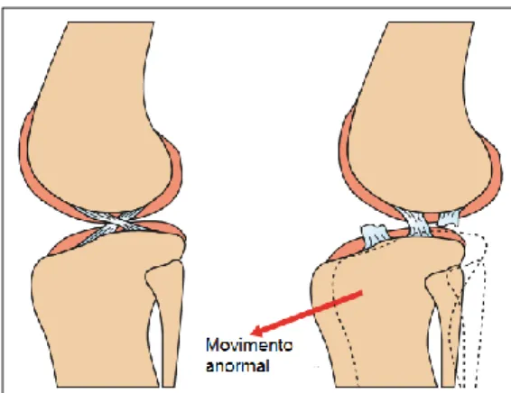 Figura 9: Esquematização do movimento anormal da tíbia num joelho com RLCCr (à direita) e de um  joelho normal (à esquerda) (adaptado de Schulz, 2013)
