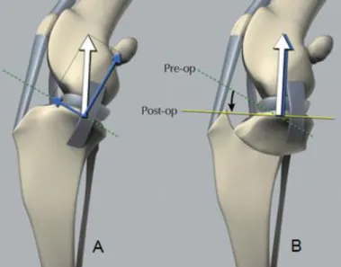 Figura 10: Esquematização da TPLO e a consequente alteração das forças aplicadas ao joelho