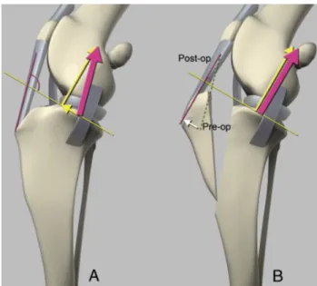 Figura 11: Esquematização da TTA e consequente alteração das forças aplicadas ao joelho