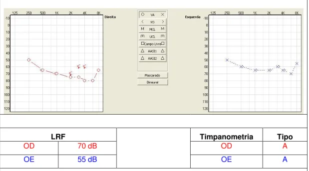 Figura 2 -  Audiometria  tonal  (via  aérea)  de  G.S.  realizada  aos  sete  anos  e  nove  meses de idade [Adaptada do software NOAH versão 3.5.2 2200C - HINSA] 
