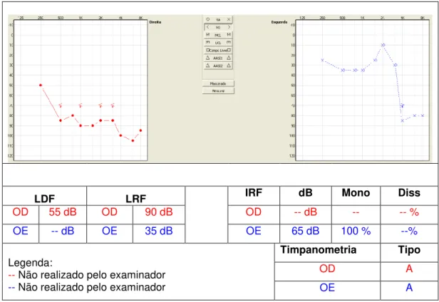 Figura 4 -  Audiometria  tonal  (via  aérea)  de  C.G.M.  realizada  aos  10  anos  e  nove  meses de idade [Adaptada do software NOAH versão 3.5.2 2200C - HINSA] 