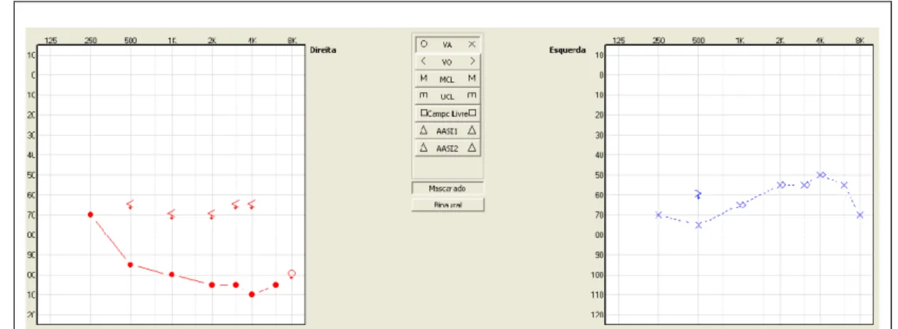 Figura 6 -  Audiometria tonal (via aérea) de A.L.R. realizada aos 12 anos e três meses  de idade [Adaptada do software NOAH versão 3.5.2 2200C - HINSA] 