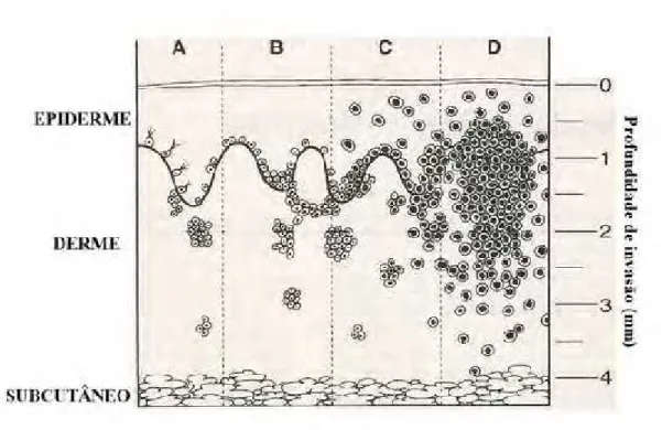 Figura 2 - Progressão da lesão dos melanócitos e a profundidade da invasão nos                    tecidos cutâneos