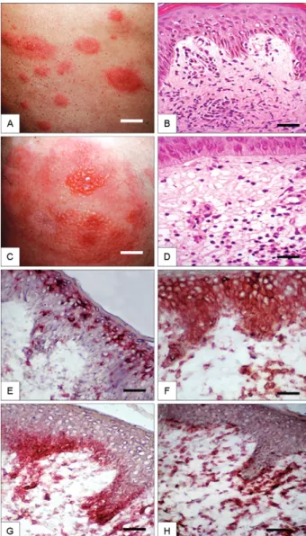 Fig.  1:  clinical  lesions  of  erythema  multiforme  (EM)  correlate  with  histopathological  aspects  of  skin  biopsies  and  show  cell-mediated  immunity (CMI) tissue parameters