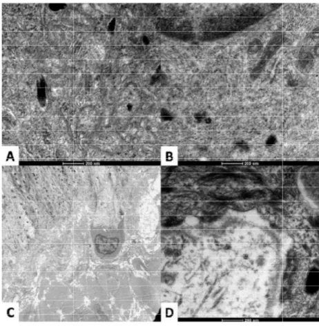 Figure 2. Transmission Electronic Microscopy from melasma and normal adjacent facial skin