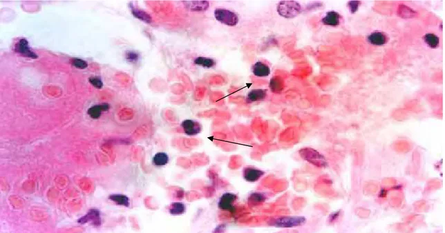 Figura 14. Fotomicrografia de tecido renal de camundongo L IV-A infectado. Presença de congestão, edema e alguns infiltrados inflamatórios (setas)