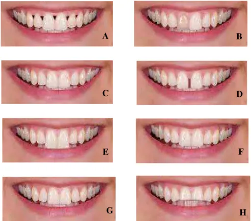 FIGURA 3 - A – sorriso buraco negro; B - sorriso com dente escuro; C - sorriso com desvio de linha média; D - sorriso com diastema; E  sorriso com incisivo aumentado; F  -sorriso com angulação do plano oclusal; G - -sorriso com lateral distalizado; H - sor