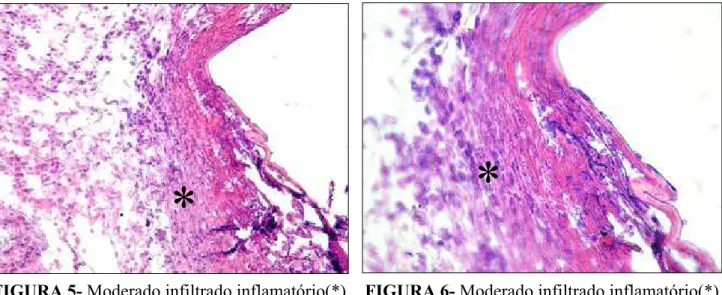 FIGURA 6- Moderado infiltrado inflamatório(*).                                                                H.E