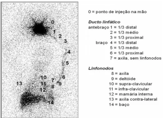 Figura 1. Imagem estática de linfocintilografia abrangendo desde a mão até a região abdominal utilizada para a classificação ordinal sequencial do ponto de chegada do radiofármaco, desde o ponto de injeção, com classificação mínima até o baço classificada 