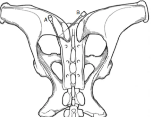 Fig. 3 : Esquema das duas técnicas de analgesia da região SI: (A) Acesso dorsal ;(B) Acesso medial 15