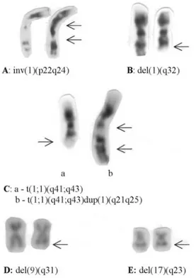 Figure 1 - Chromosome aberrations involving breakpoints at 1q24 (A), 1q32 (B), 1q41 and 1q43 (C), 9q31 (D) and 17q23 (E).