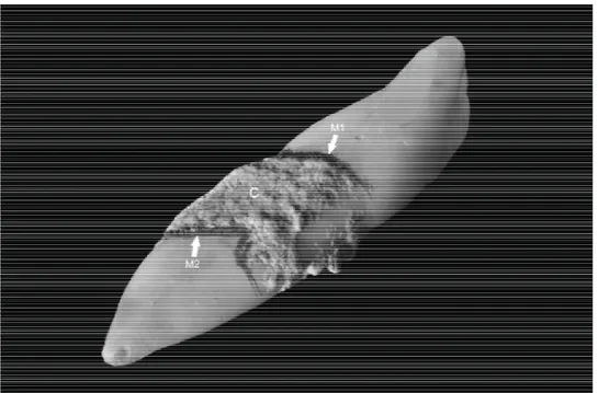 Figure 1 - Tooth lost due to periodontal disease, presenting dental calculus  adhered to the root surface