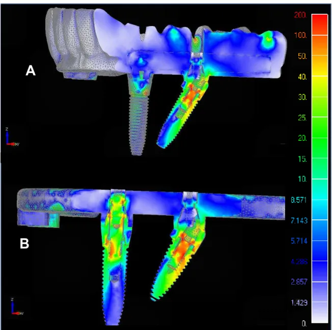 Figura 3 A e B - Corte Sagital da Prótese (A) e Infraestrutura (B) com os implantes. Mapa de tensão de von  Mises – Carga Axial – Modelo Implantes Inclinados
