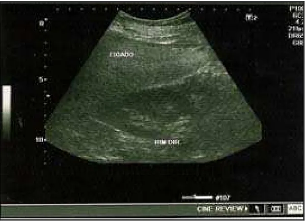 Figura 7. Imagem ultrassonográfica de esteatose hepática grave em comparação com  parênquima renal