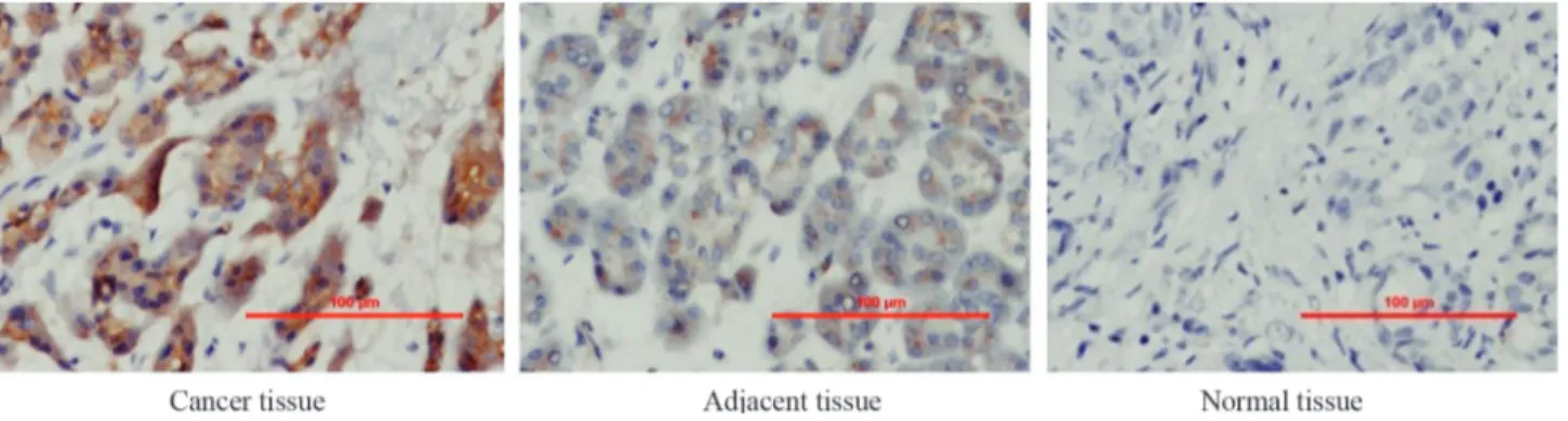 Figure 1 - Immunohistochemical analysis of ILK expression in prostate cancer tissue, adjacent tissue and normal tissue