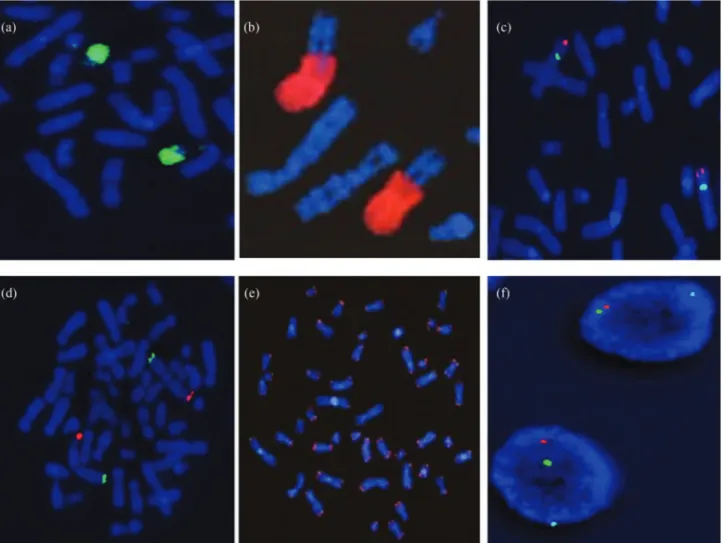 Figure 2 - FISH with different types of probes and partial metaphases. (a) Whole chromosome 21 painting; (b) partial chromosome painting probe for the long arm of chromosome 9; (c) locus-specific probe for chromosome 4p16.3 (red) and Alfa satellite probe 4