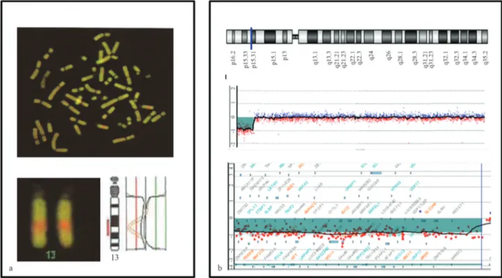 Figure 3 - Comparative Genomic Hybridization. (A) Conventional CGH analysis: a mixture of test DNA from a patient and a normal reference DNA la- la-beled with different fluorochromes are hybridized to normal chromosome spreads (top panel)