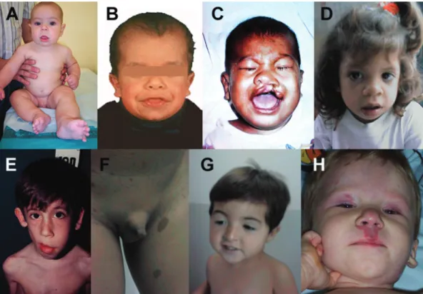Figure 1 - Phenotypic presentations in some genetic developmental syndromes that have an increased risk of developing cancer