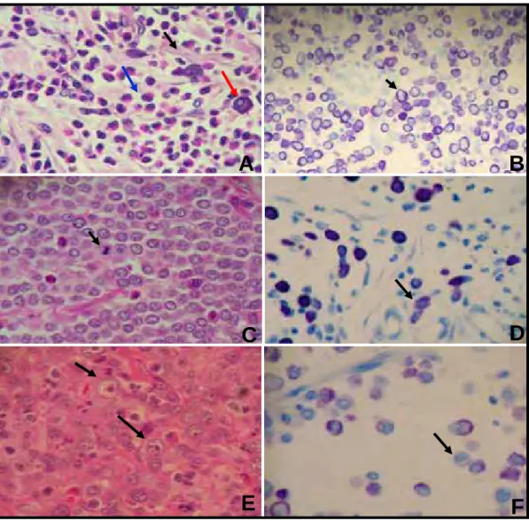 Figura 1-  Fotomicrografias de mastocitomas de cães utilizados neste estudo, com aumento de  400 vezes, (A, C e E coloração de Hematoxilina-eosina); (B, D e F coloração de Azul  de Toluidina): (A) Mastocitoma grau I, notar citoplasma com bordas bem definid