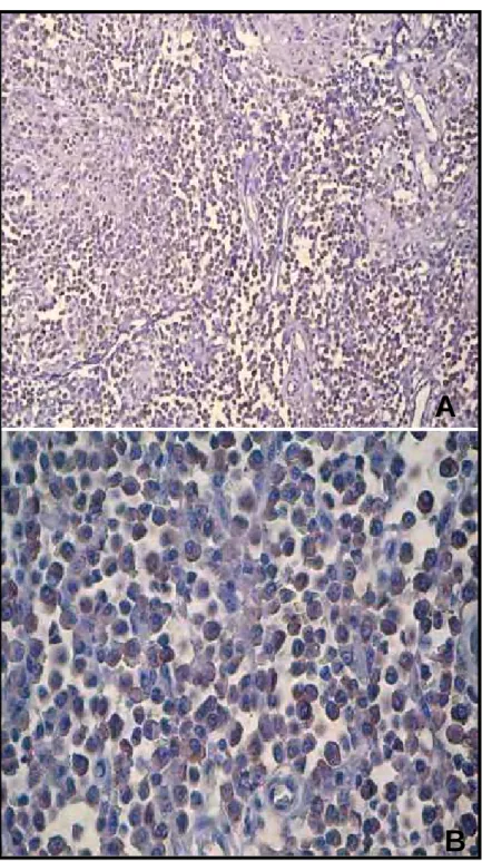 Figura 7 - Fotomicrografias de mastocitomas caninos grau II (G2), submetidos à  reação de imunoistoquímica pelo método ABC, utilizando o anticorpo  anti-COX-2, clone CX 294