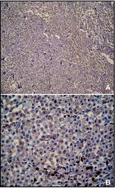 Figura 9 - Fotomicrografias de mastocitomas caninos grau I (G1), submetidos à  reação de imunoistoquímica pelo método ABC, ilustrando grande  número de macrófagos associados ao tumor
