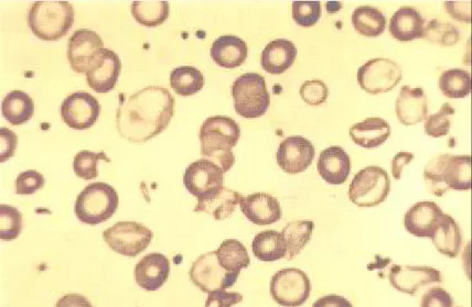 Figura 14: Esfregaço sangüíneo apresentando discretas alterações dos eritrócitos  (Fonte: LHGDH)