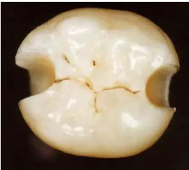FIGURA  9  –   Vista oclusal de um dente após a confecção  dos preparos  cavitários. Observar no preparo da fase mesial, a existencia de  esmalte no cavo superficial da parede cervical  (detalhe)