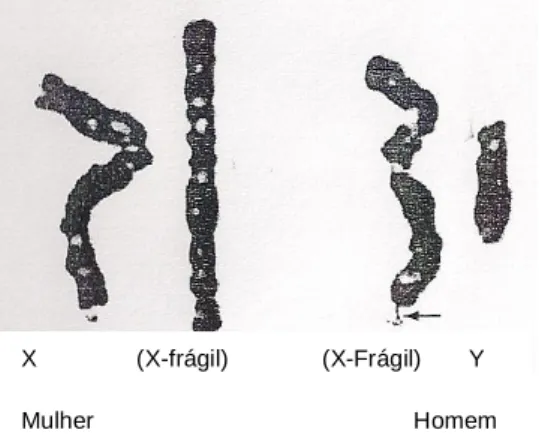 Figura  1.  Localização  do  gene  X-Frágil  (FMR1)  no  cromossoma  X  (Carjaval  &amp; 