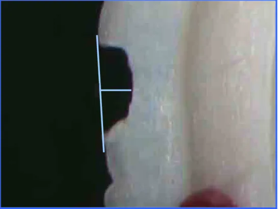FIGURA 2 – Medida do perfil da cavidade utilizando o traçado do  programa Leica Qwin. 