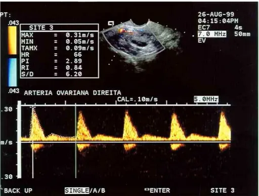 Figura 4 - Padrão de registro das ondas de velocidade de fluxo na artéria  ovariana 